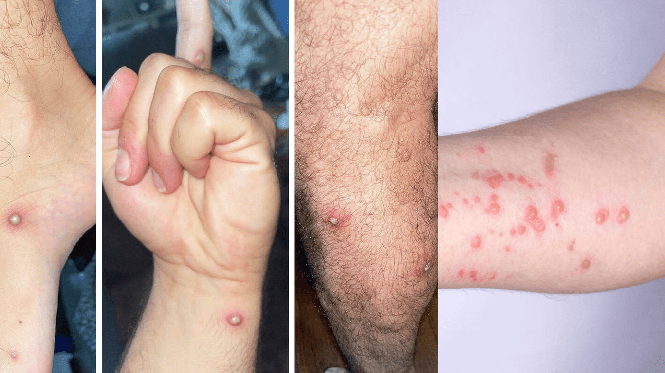 Understanding Monkey pox: Symptoms, Treatment, and Prevention