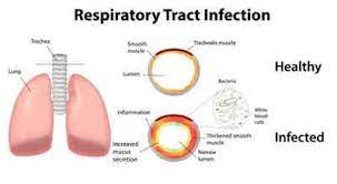Reduced Risk of Respiratory Infections
